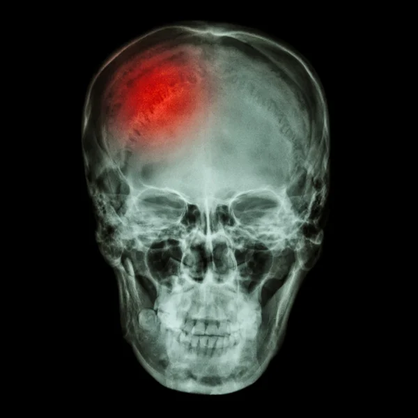 tumors in skull