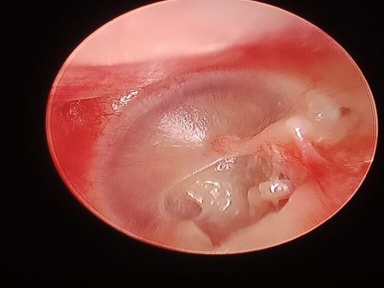 Why We Choose Endoscopic Tympanoplasty: A Modern Approach to Ear Health