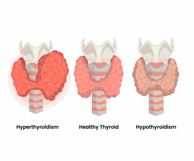 Hyperthyroidism vs Hypothyroidism: Symptoms, Causes, Diagnosis & Treatment for Common Thyroid Disorders