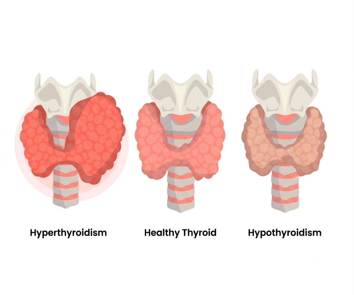 Hyperthyroidism vs Hypothyroidism: Symptoms, Causes, Diagnosis & Treatment for Common Thyroid Disorders