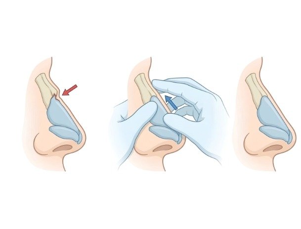 Nasal Fracture: When Should You Worry? Symptoms, Causes, Diagnosis & Treatment Options
